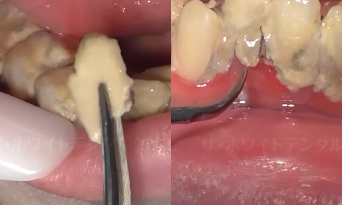 หมอฟันญี่ปุ่นอึ้ง เจอ \