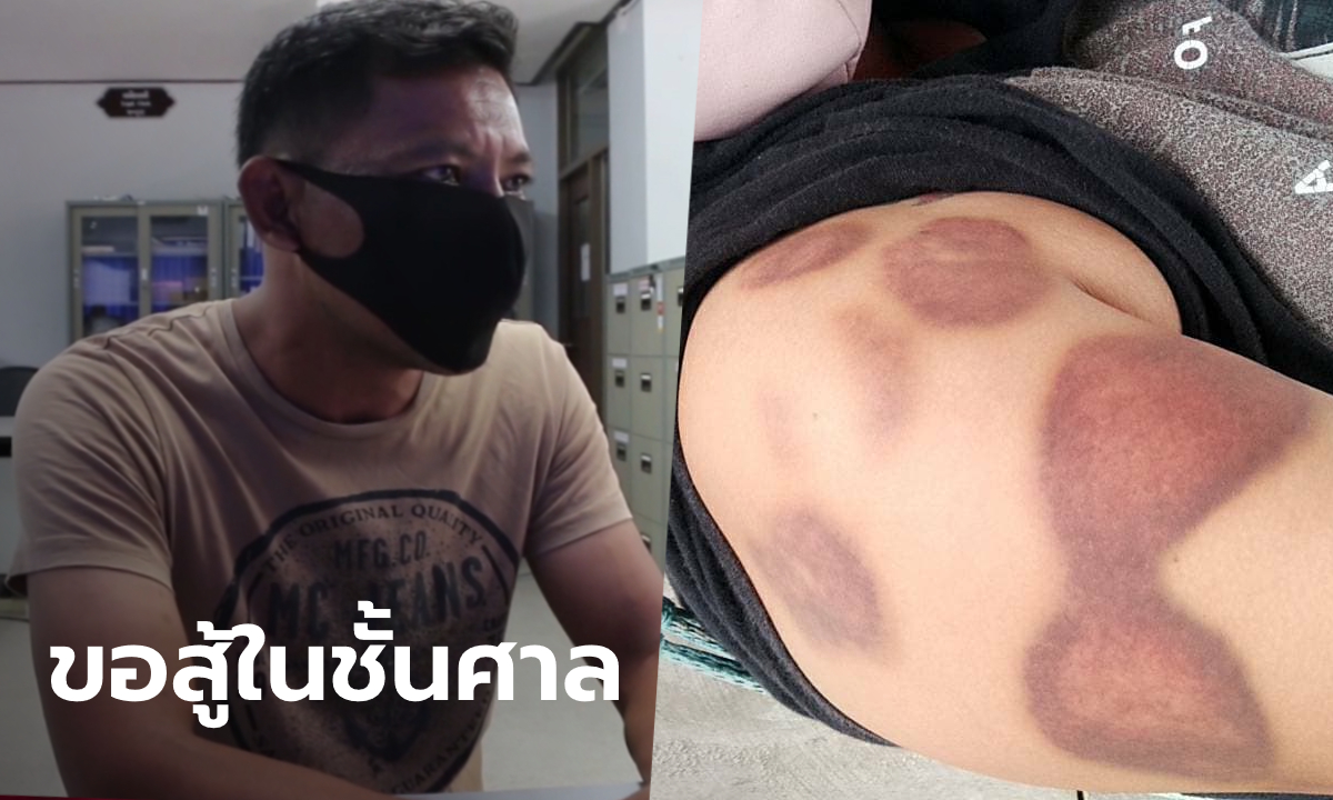 ผู้ใหญ่บ้านดอดเจอตำรวจ ปฏิเสธทุกข้อกล่าวหา หลังถูกแจ้งจับซาดิสม์กัดหลานสาวช้ำทั้งตัว