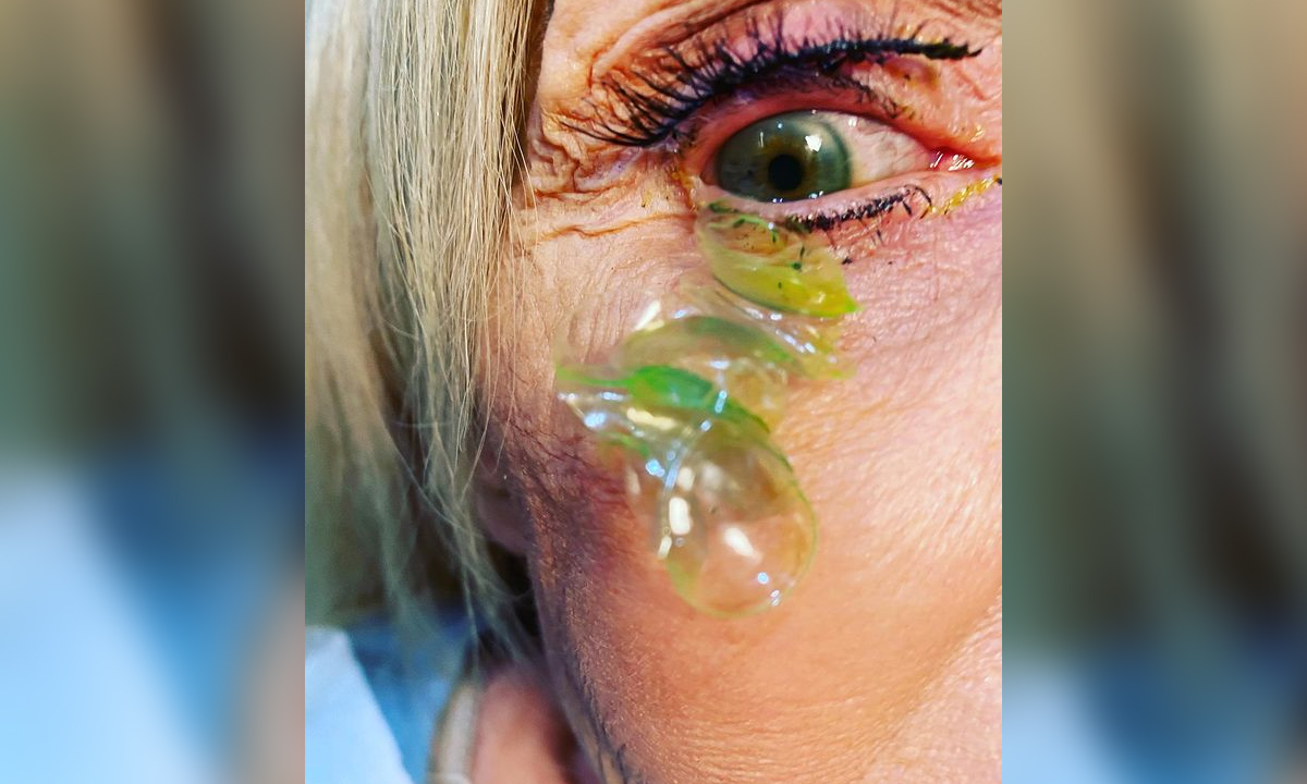 คลิปสยอง คนไข้ลืมถอดคอนแทคเลนส์ หมอช่วยเขี่ยออก นับได้ 23 อันในตาเดียว!