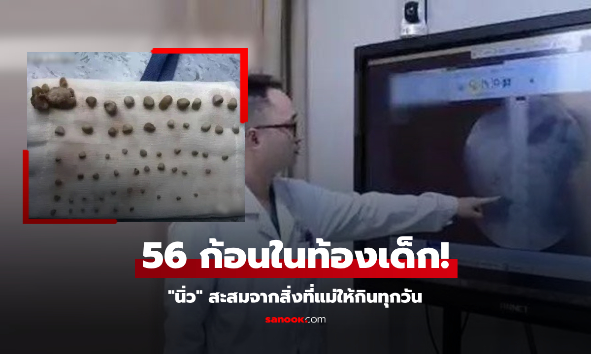 ด.ช. 9 ขวบ มีนิ่วในท้อง 56 ก้อน หมอเผยต้นเหตุทำแม่ทรุด ที่แท้คือสิ่งที่ให้ลูกกินทุกวัน