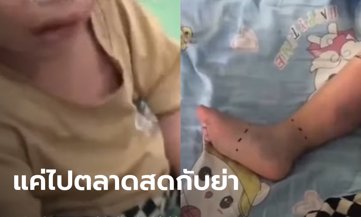 พ่อ-ย่าใจสลาย ด.ช. 2 ขวบ อาจต้องถูกตัดเท้าขวา ช็อกจุดเริ่มต้นจากพาไปตลาด