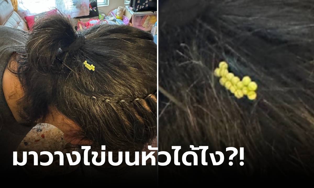 ผงะ หนุ่มโดนตัวนี้ "วางไข่" บนหัว นับจำนวนเม็ดยิ่งขนลุก เยอะจนเหมือนพวงองุ่น!