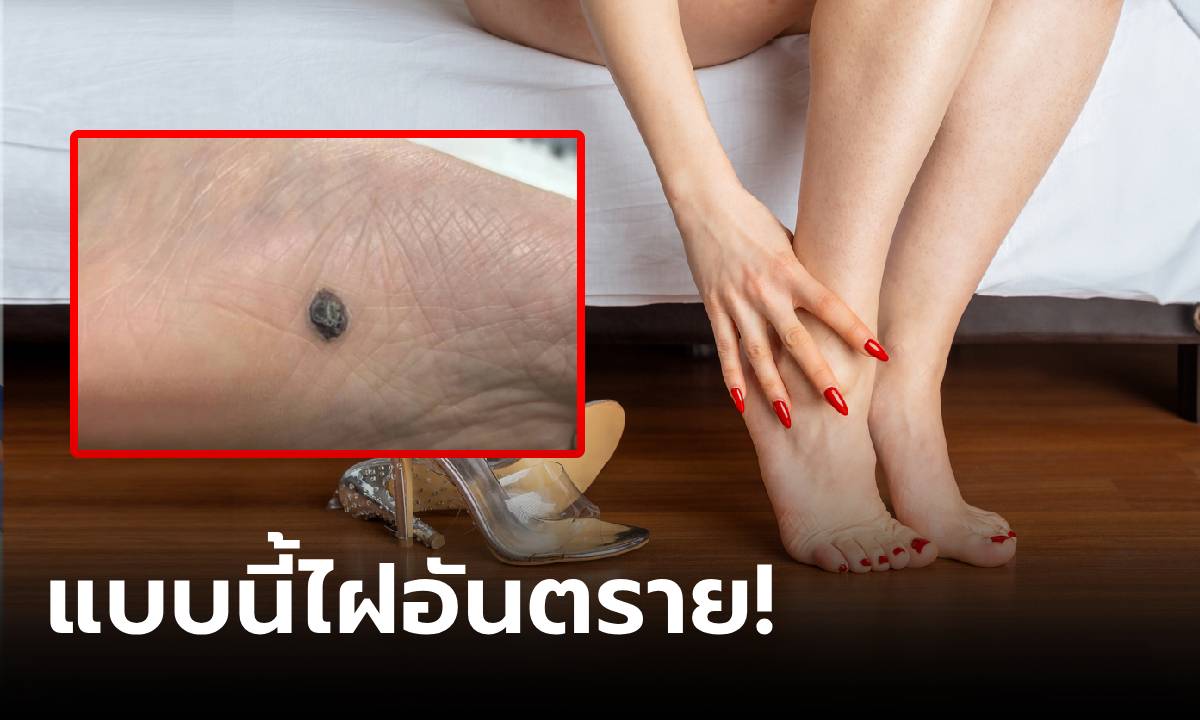 สาวมีไฝใต้ฝ่าเท้า ภูมิใจเป็น \