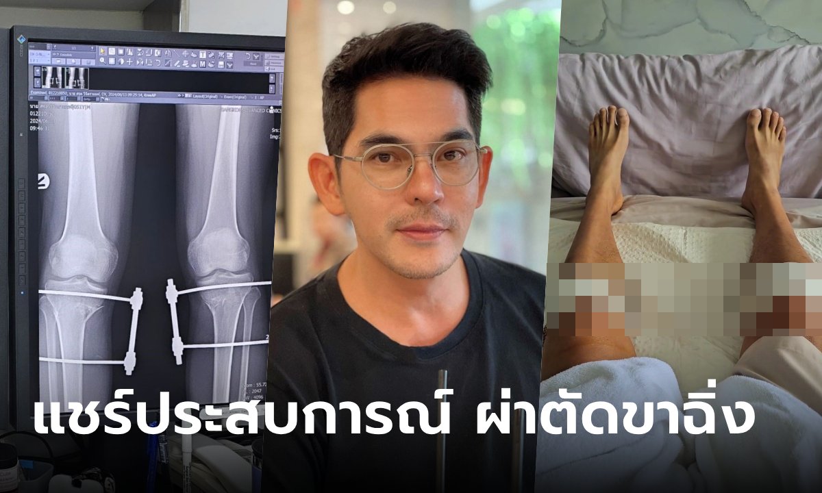 ขาฉิ่ง คืออะไร? บิ๊ก ศรุต ทนเจ็บปวดทรมาน ตัดสินใจผ่าตัด แชร์ประสบการณ์ตรง