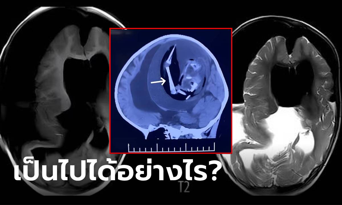 อ่านไม่ผิด! พบ “ตัวอ่อนทารก” อยู่ในศีรษะเด็ก 1 ขวบ คาดเป็นพี่สาวฝาแฝด