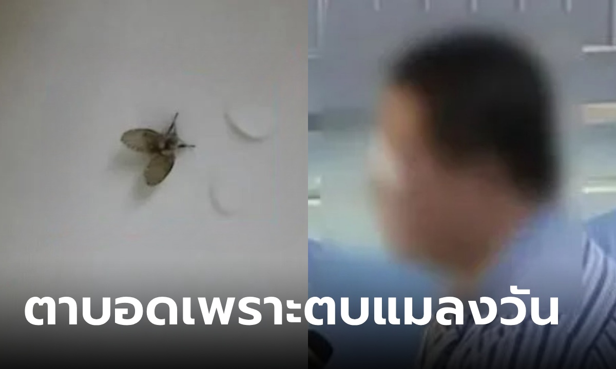 หนุ่มดวงตาติดเชื้อ หมอต้องควักออกก่อนลามสู่สมอง สุดช็อกต้นเหตุเพราะตบแมลงวันตัวเดียว
