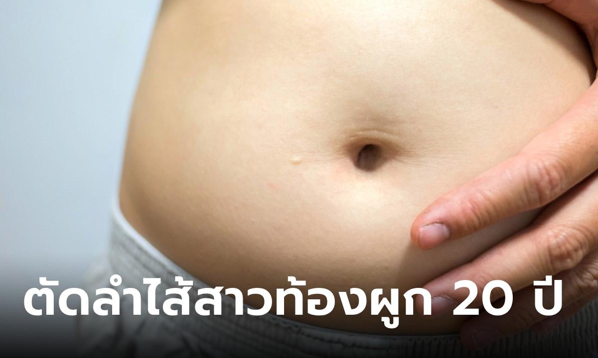 สาว 29 ท้องผูก 20 ปี จนลำไส้ตาย ผ่าตัดออกมาอัดแน่นด้วยอึ ใหญ่ยาวยังกับงูเหลือม