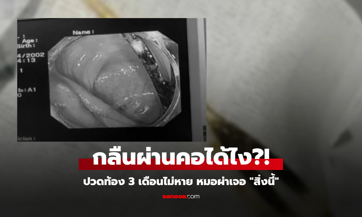 เกือบจัดงานศพ หนุ่มปวดท้องเป็นเดือนๆ ไม่หาย หมอผ่า \