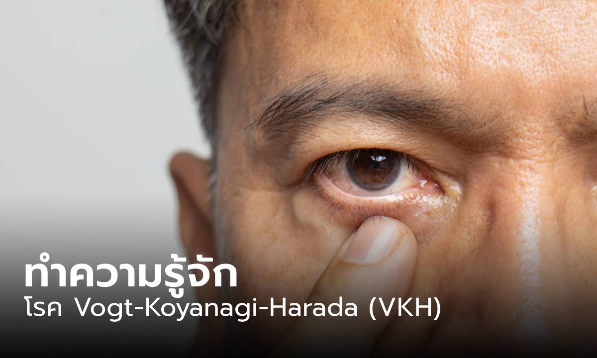 รู้จัก “โรค Vogt Koyanagi Harada (VKH) ” คืออะไร หลัง \'กิต Three Man Down\' ป่วย