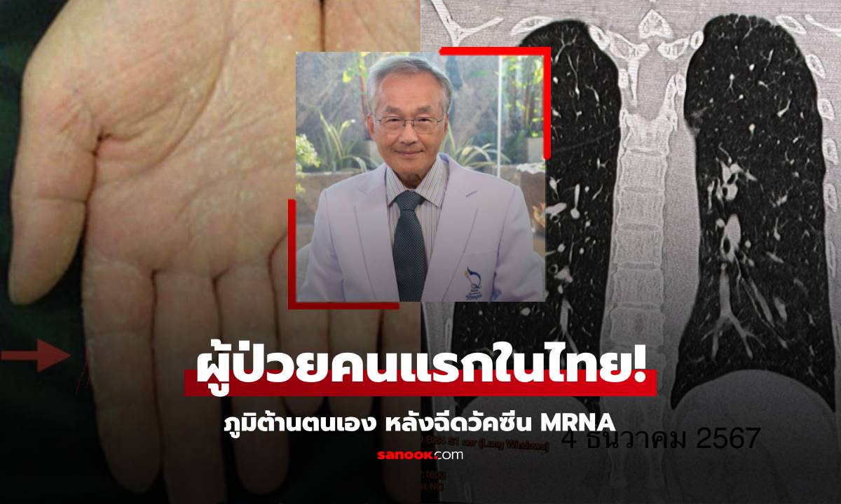 คนแรกในไทย! ฉีดวัคซีน mRNA ป่วยภูมิต้านตนเอง นพ.มนูญ ย้ำมีอาการนี้ "ห้าม" ฉีดเข็มต่อไป