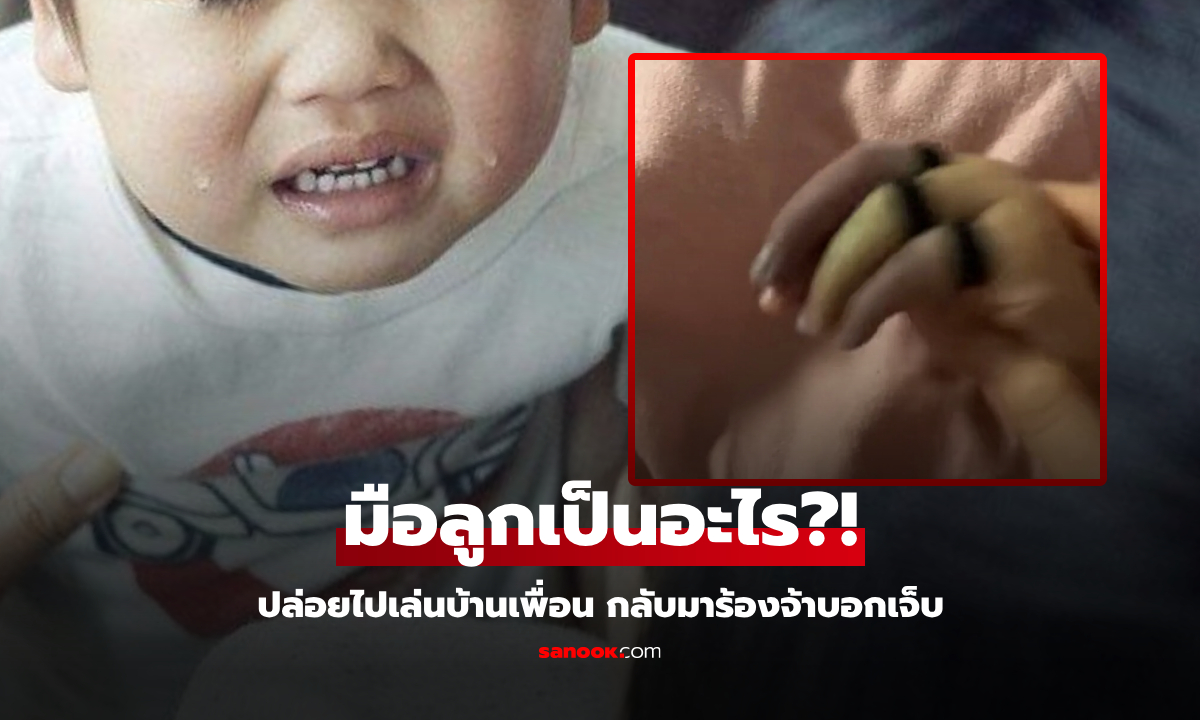 แม่ใจร่วง ลูกไปเล่นบ้านเพื่อน กลับมาร้องไห้จ้า “ขอให้ช่วย”  มือบวมสีม่วงคล้ำ ทั้งสองข้าง!