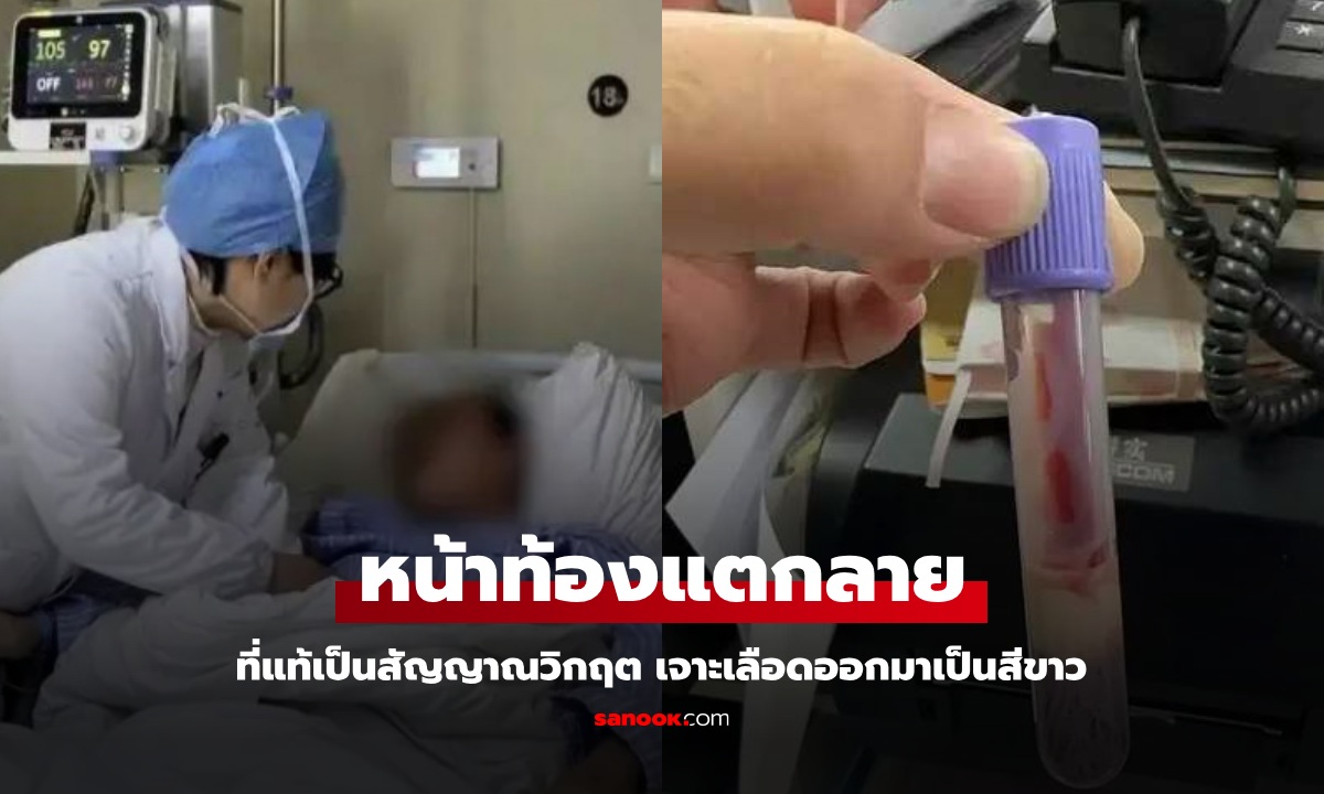 สัญญาณวิกฤต "หน้าท้องแตกลาย" ชายวัย 44 เจาะเลือดเป็นสีขาว รู้ประวัติแล้วไม่แปลกใจ