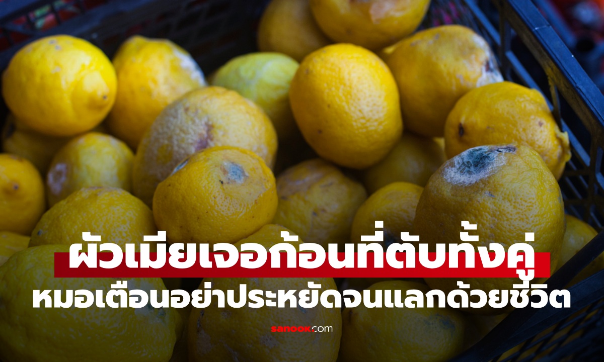 ผัวเมียเจอก้อนในตับ ทั้งที่ไม่ดื่ม-ไม่สูบ หมอเตือน อย่าประหยัดจนต้องแลกด้วยชีวิต