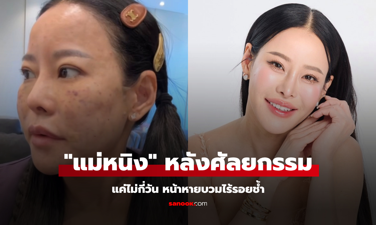 เปิดภาพ "หนิง ปณิตา" หลังศัลยกรรม แค่ไม่กี่วัน หน้าหายบวมไร้รอยช้ำ