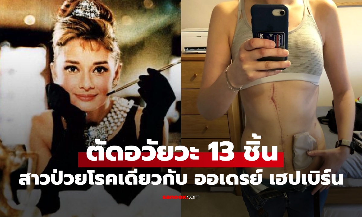 สาวป่วยโรคร้ายเหมือนกับ "ออเดรย์ เฮปเบิร์น" หมอแจ้งข่าวร้าย หลังตัดอวัยวะทิ้ง 13 ชิ้น