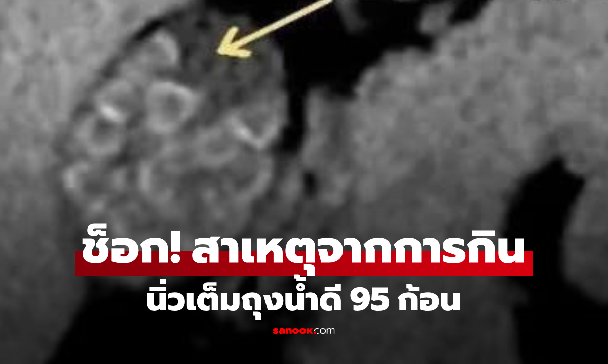 หมอตกใจ! หญิงปวดท้องหนัก ผ่านิ่ว 95 ก้อน \