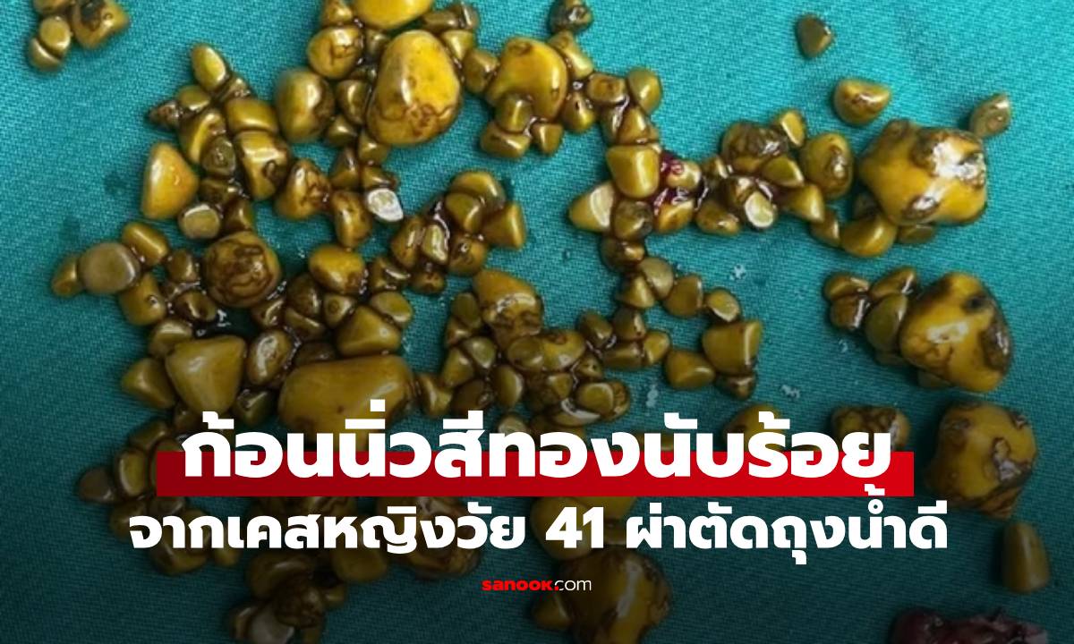 หญิงวัย 41 ผ่าตัดด่วน พบ \