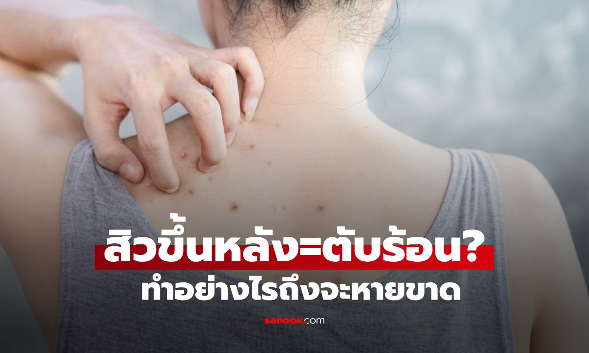 อาบน้ำสะอาดแล้ว แต่ยังมี  “สิวที่หลัง” เกิดจากตับร้อนใช่ไหม ทำยังไงถึงจะหายขาด?!