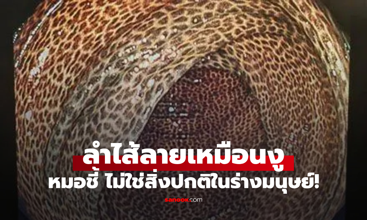 ไม่ใช่หนังงู แต่คือลำไส้มนุษย์ คนไข้เผยสิ่งที่ \