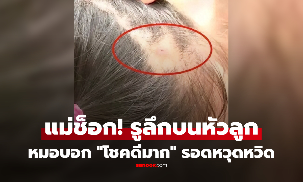 แม่ใจร่วง รูลึกบนหัวลูก หมอดึงสิ่งที่ฝังอยู่ออก ถึงกับบอก “เด็กคนนี้โชคดีมาก” ที่มารักษาทัน!
