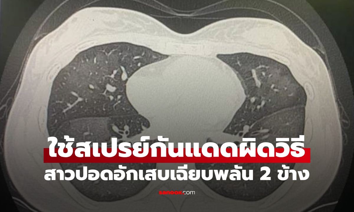 สาวฉีดสเปรย์กันแดดไม่ถึง 1 นาที ป่วยกะทันหัน อึ้งผลเอกซเรย์ ปอดขาว 2 ข้าง