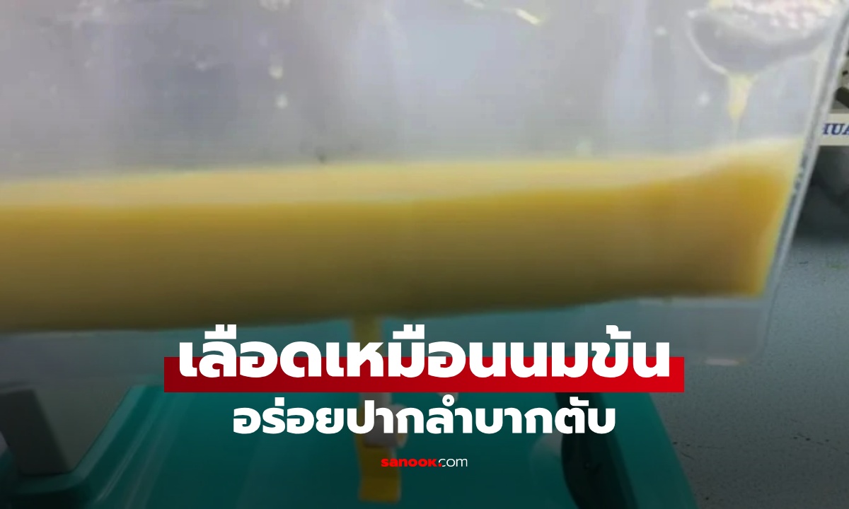 เลือดเหมือนนมข้น! หนุ่มวัย 34 เกือบตายเพราะอาหารเมนูโปรด อร่อยปากลำบากตับ