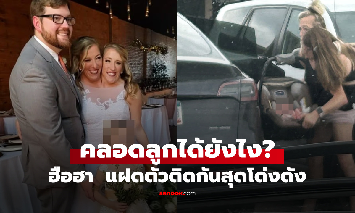 แห่แชร์รูป! แฝดตัวติดกันคู่ดังของโลก \