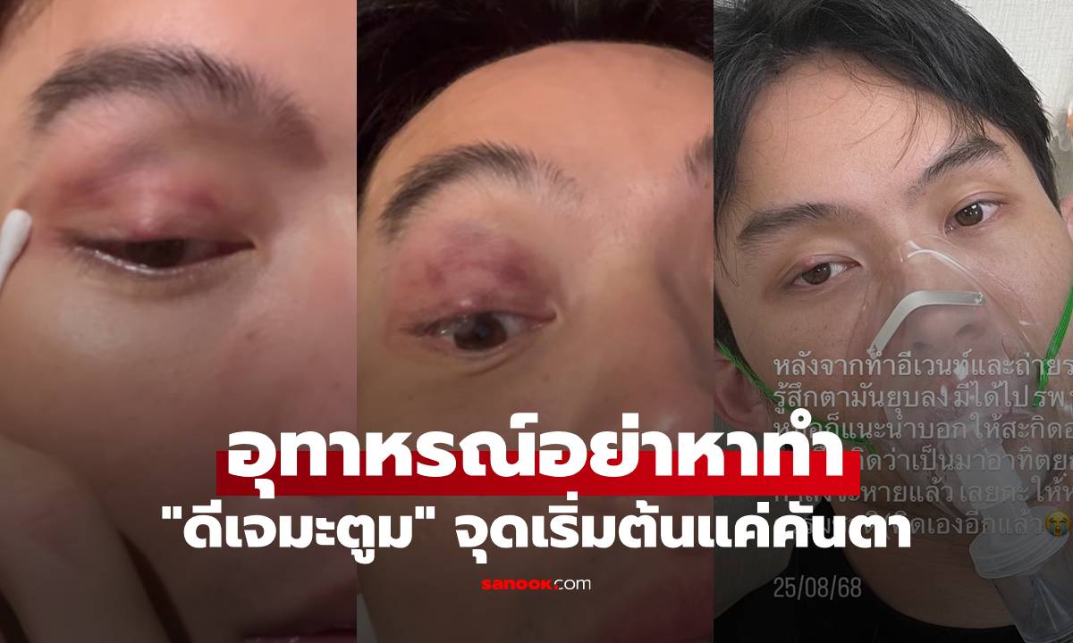 "ดีเจมะตูม" แชร์อุทาหรณ์อย่าหาทำ จุดเริ่มต้นแค่คันตา สุดท้ายเป็นหนักกว่าเดิม