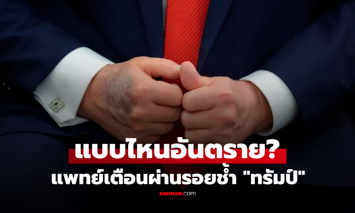 รอยช้ำแบบไหน \