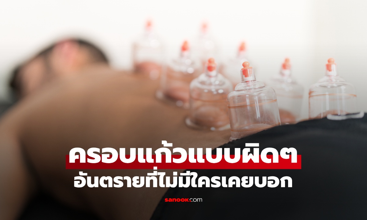 ชายปวดหลัง ครอบแก้วติดต่อกัน 2 วัน ผลลัพธ์จำจนตาย อันตรายที่ไม่มีใครบอก