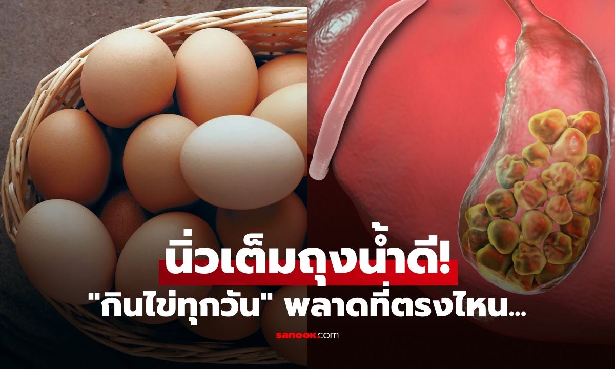 หนุ่มวัย 23 นิ่วใหญ่เต็มถุงน้ำดี แค่เพราะ \