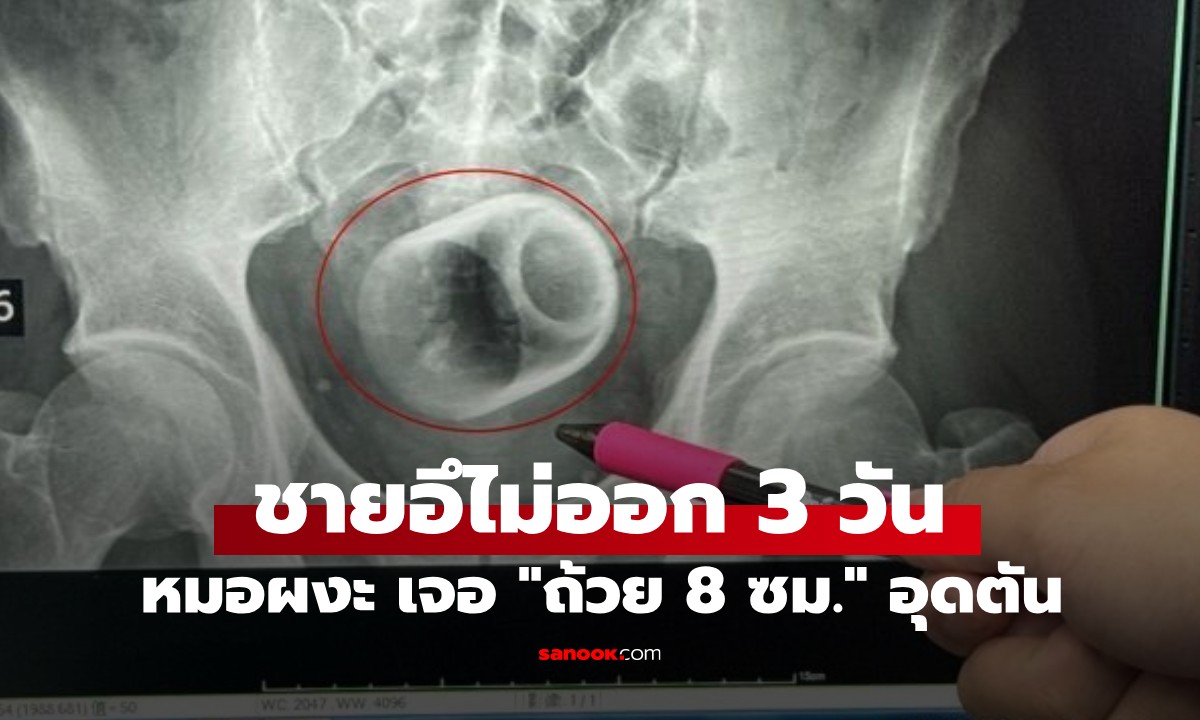 ชายปวดท้องหนัก 3 วัน ถ่ายไม่ออก! หมอผงะ เจอ \