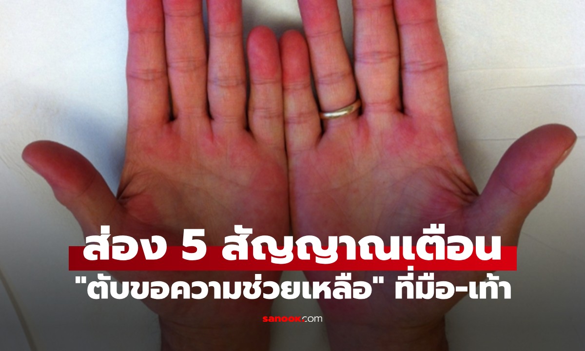 แค่ดูมือดูเท้า ก็จะรู้ว่า “สัญญาณตับมีปัญหา” ต้องรีบสังเกต 5 อาการสำคัญ