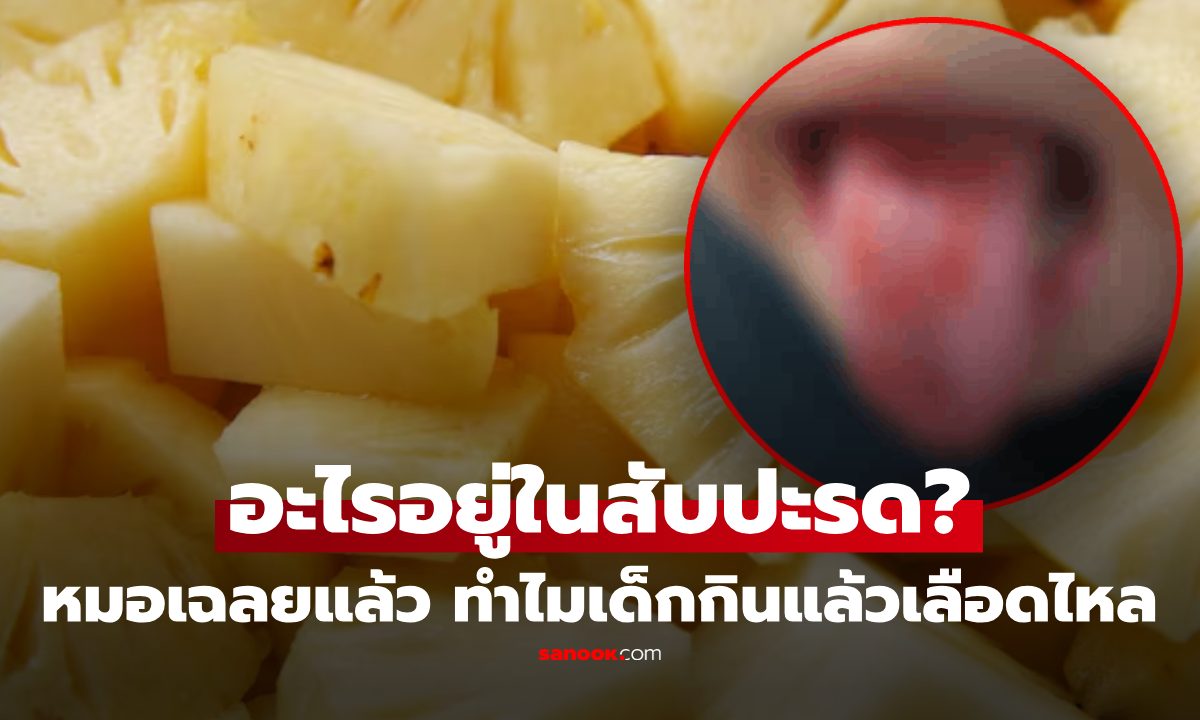 เด็กกินสับปะรด เลือดไหลเต็มลิ้น เพราะอะไร? หมอเฉลยแล้ว ไม่ได้แพ้ แต่มักเกิดในเด็ก