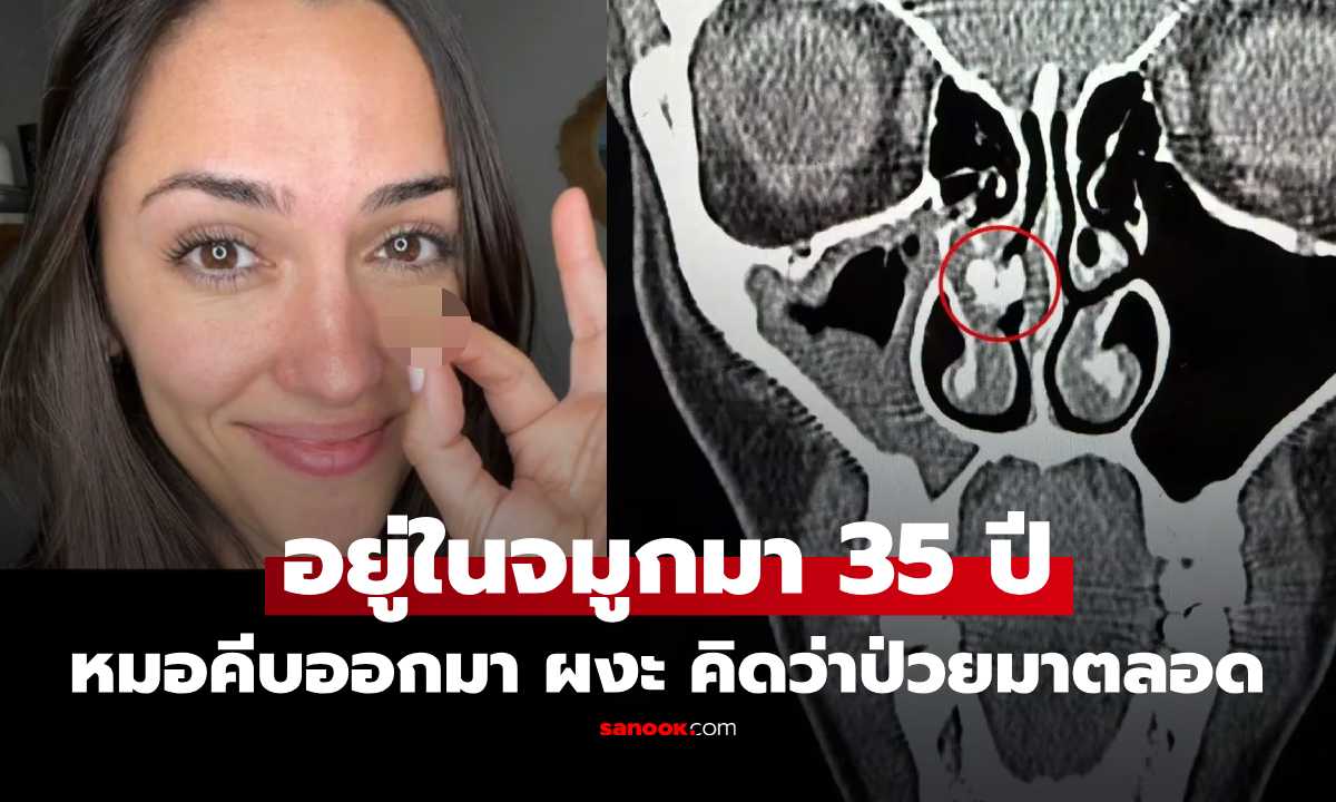 หญิงวัย 35 ป่วยไซนัสทั้งชีวิต ก่อนหมอพบ \