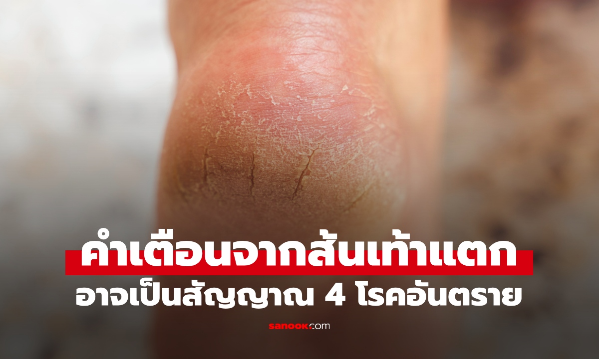 ส้นเท้าแตกอาจไม่ใช่แค่ผิวแห้ง แต่เป็นสัญญาณ 4 โรคอันตรายที่ซ่อนอยู่