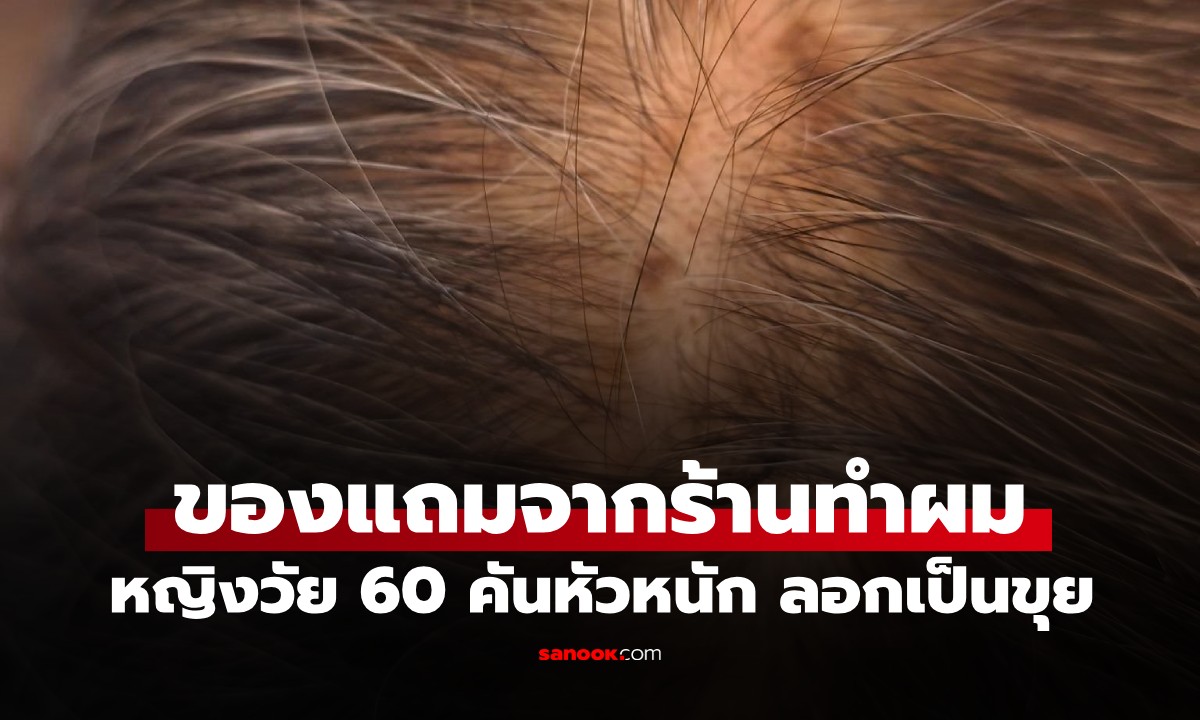 หญิงวัย 60 คันหัวหนัก ลอกเป็นขุย หมอใช้ไฟส่องเห็นแสงประหลาด รู้ทันทีเป็นอะไร