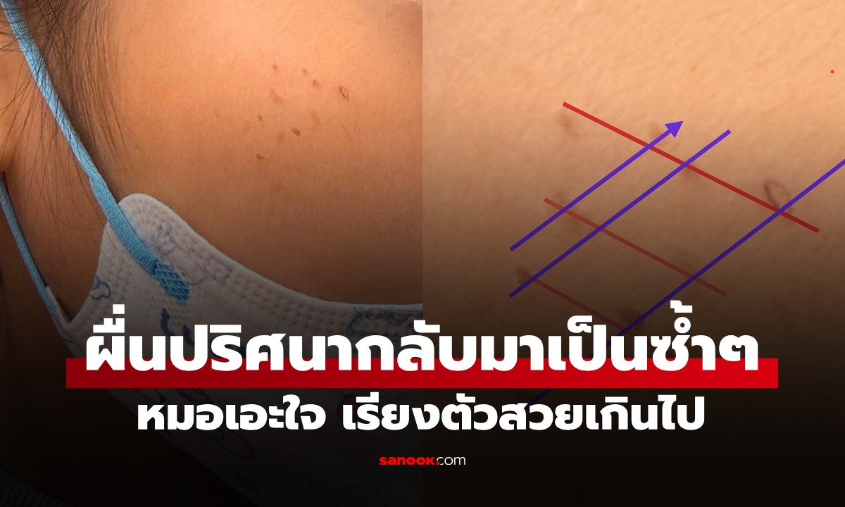 ลูกสาวมีผื่นปริศนากลับมาเป็นซ้ำๆ หมอเอะใจ เรียงตัวสวยเกินไป ถามแม่นิดเดียวรู้เรื่อง!