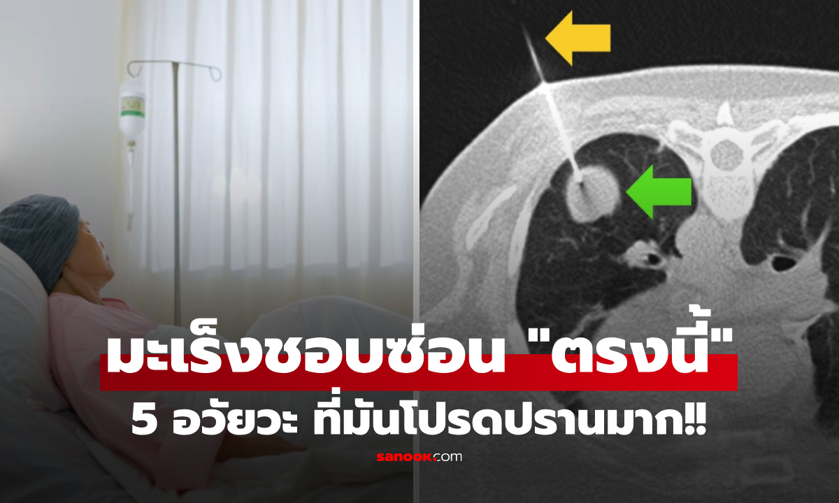 เช็กด่วน! 5 อวัยวะที่เซลล์มะเร็ง \