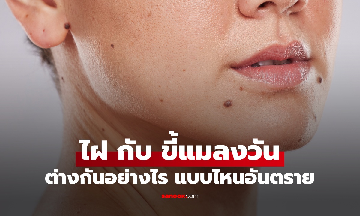 ไฝ กับ ขี้แมลงวัน ต่างกันยังไง? รู้จักวิธีสังเกตและเฝ้าระวัง แบบไหนที่ควรพบแพทย์