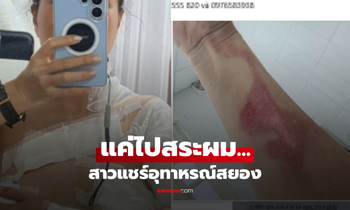 สาวเข้าร้าน "สระผม" หวังผ่อนคลาย สุดท้ายได้แผลไหม้เสียโฉม ต้องหามส่งหมอด่วน!