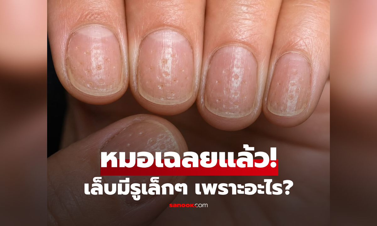 เล็บคุณมีรูเล็กๆ? แพทย์ชี้เป็นสัญญาณเตือน "โรคนี้" อย่าคิดแค่ขาดแคลเซียม!