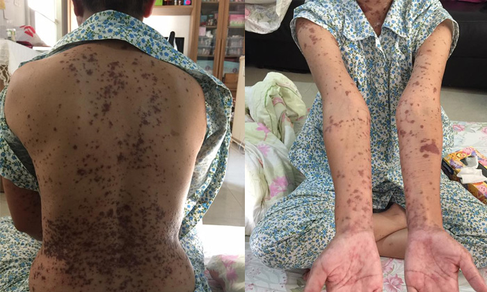 แชร์สนั่น! ขอรับบริจาครกเด็กเพื่อใช้ผ่าตัดตาสาวแพ้ยาหนัก